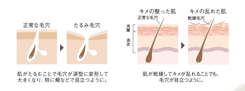 毛穴、たるみの仕組み